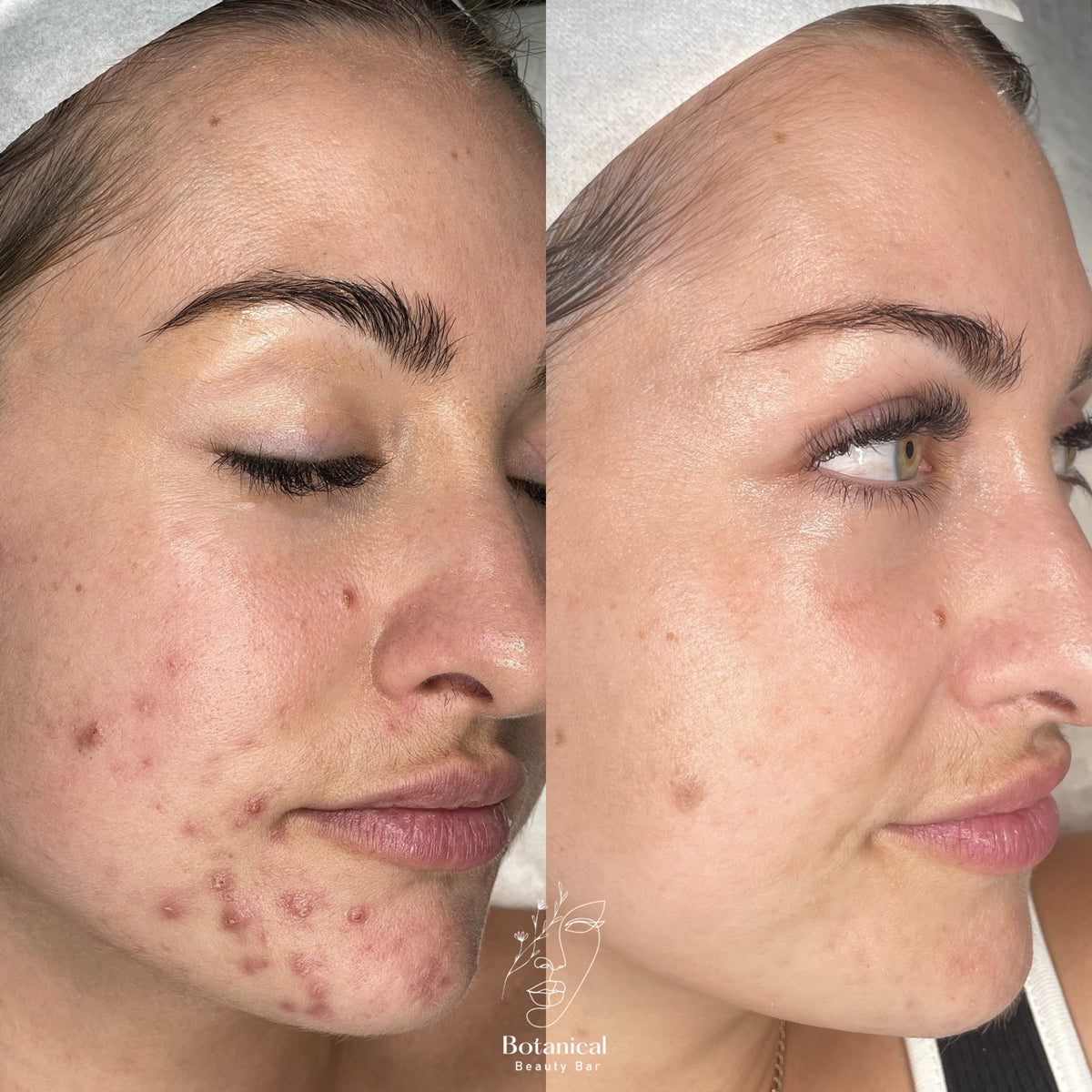 Botanical Beauty Bar client skin before and after result