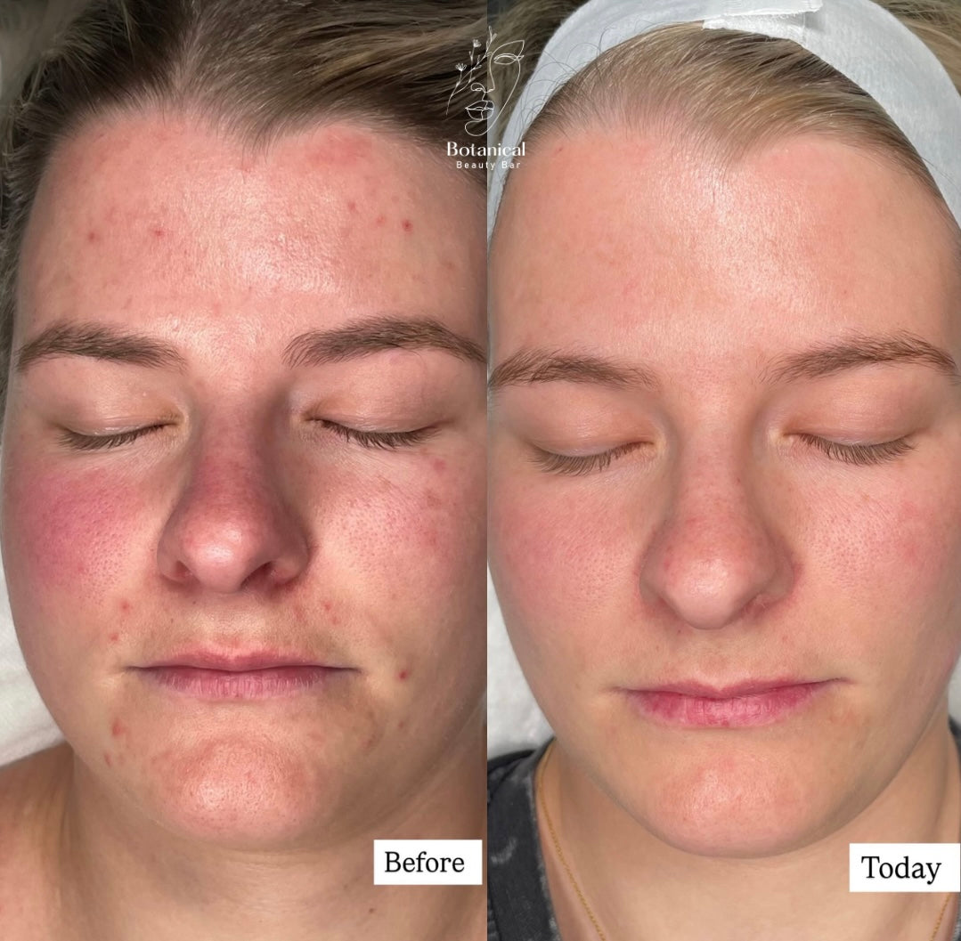 Botanical Beauty Bar client skin before and after result