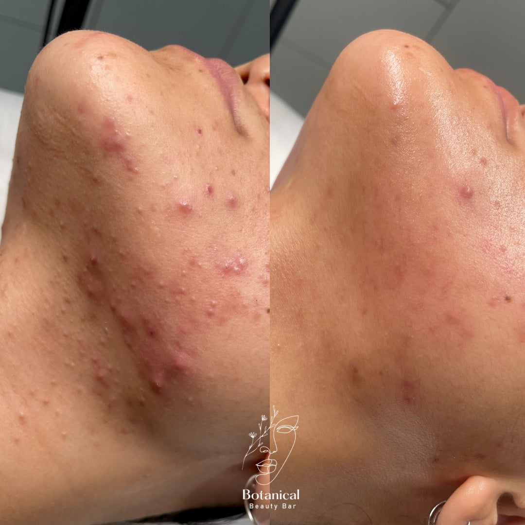 Botanical Beauty Bar client skin before and after result