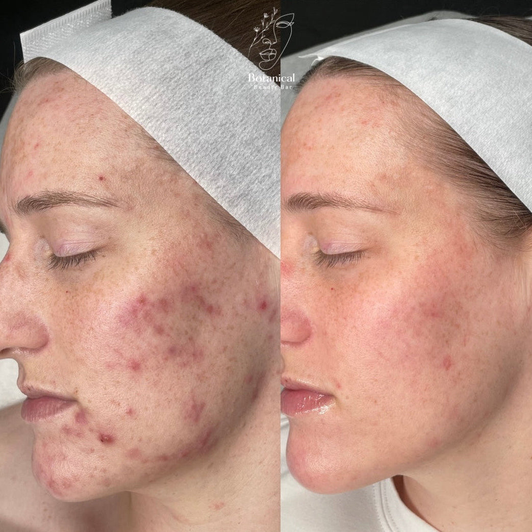 Botanical Beauty Bar client skin before and after result