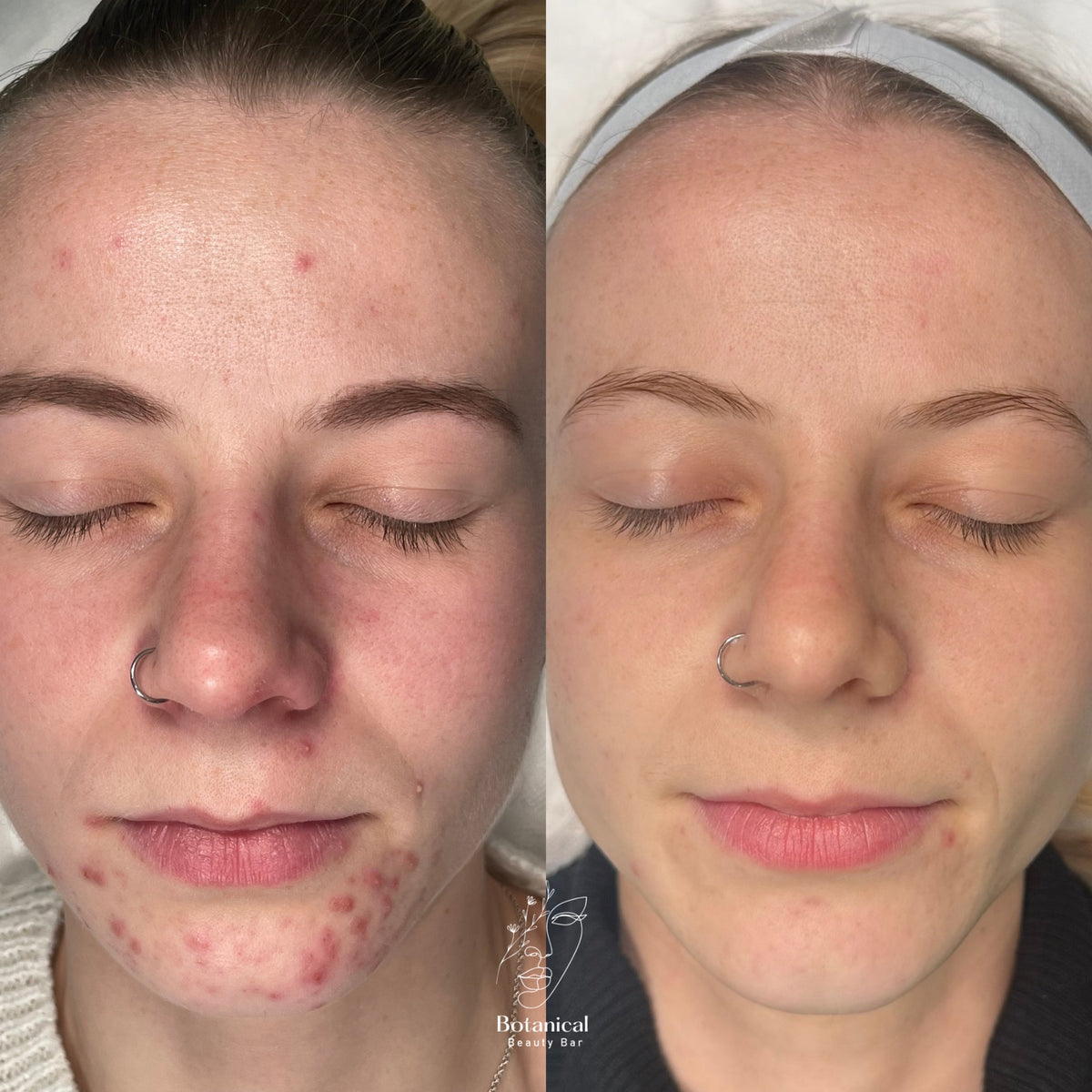 Botanical Beauty Bar client skin before and after result
