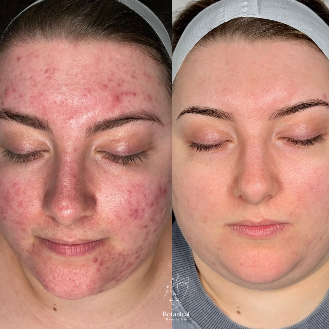 Botanical Beauty Bar client acne before and after skin result